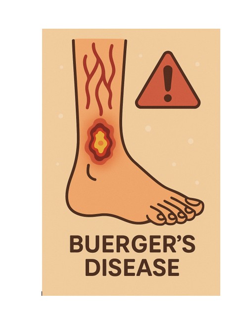 عفونت زخم بیماری بورگر